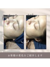 ファロンビューティー(fallon beauty)/国産ハーブピーリング♪