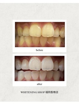 ホワイトニングショップ 福岡香椎店/美容ホワイトニング