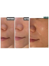 ローズムーン(Rose.Moon)/セラピール3回目