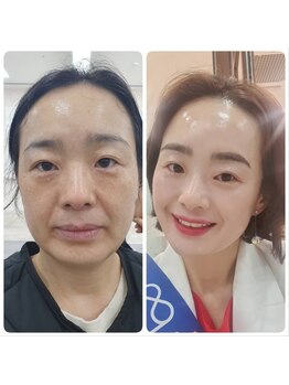 ココ(COCO)/口横たるみ/頬こけ/リフトアップ