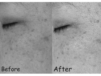 マインドール/40代シミ毛穴でお悩み