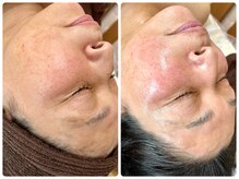 シシエル(CHICIEL)/光フェイシャルでツヤ トーンUP