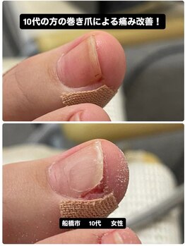 巻き爪じゅん 船橋店/陥入爪の痛み改善の施術!