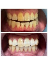 オーシャンハーブ(Ocean Harb)/【セルフホワイトニング福井市】