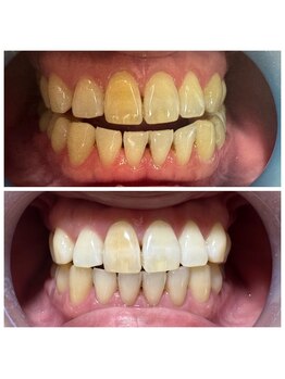 オーシャンハーブ(Ocean Harb)/【セルフホワイトニング福井市】