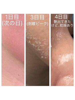 美温(mion)/剥離 ハーブピーリング