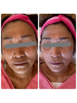 ラシック/ララピール　1回目→3回目