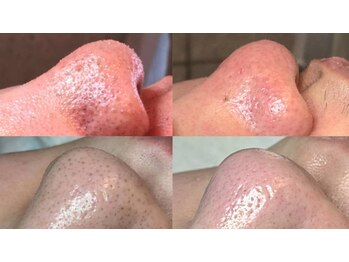 ジプソフィラフィフティドット(gypsophira15.)の写真/皮脂の多い男性の方にこそおすすめしたい毛穴エクストラクション・ハーブピーリング！