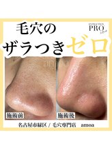 アモア(amoa)/毛穴エクストラクション