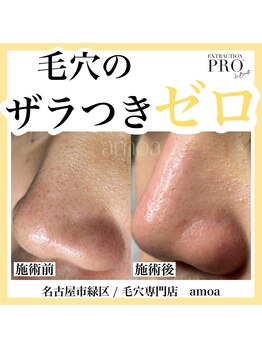 アモア(amoa)/毛穴エクストラクション