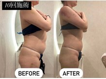 痩身革命 大宮店/ 施術写真（痩身）