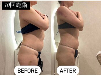 痩身革命 大宮店/ 施術写真(痩身)