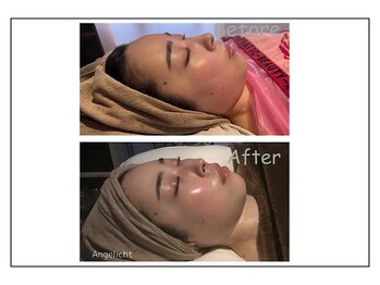 エンジェライト(Angelicht)/ララピール