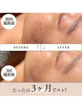 ラリリー(La Lily)/ミコステラ3か月の結果