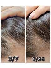 アン 銀座(ann)/生際エクソソーム21日リアル経過