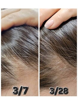 アン 銀座(ann)/生際エクソソーム21日リアル経過