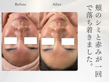 サロン ルテラ(SalonRutella)/肌質改善