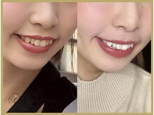 ライトケアサロン 銀座店(Light Care Salon)/セルフホワイトニングの症例写真