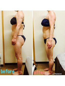 スマイルボディ つぼの森 吉野店(Smile body)/ラジオ波 全身