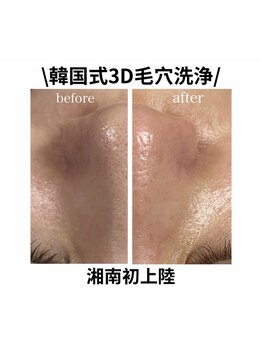 毛穴ケアをしたい