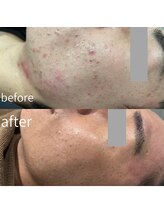 ディアー(Dear)/REVI陶肌トリートメント