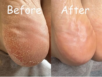 ビューティーベリッシモ(Beauty Bellissimo)/韓国式＊足裏角質ケアsplaning