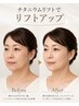 【たるみ・緩みを骨格引き締め】韓国で人気のタイトニング★チタニウムリフト