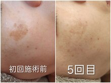 クラリス(Clarice)/シミ・イボがここまで薄くなる！