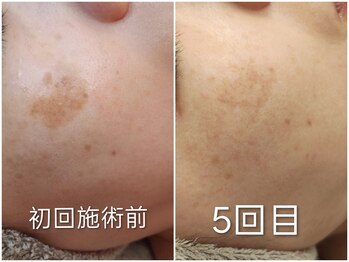 クラリス(Clarice)/シミ・イボがここまで薄くなる！