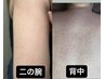 【強度なハーブ力で毛孔性へ】リピートNo.1背中/二の腕赤いブツブツ改善¥7800