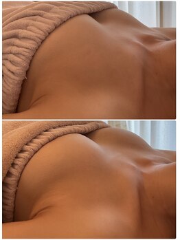 美バストアルファ(美bust α)/【バストアップ】症例