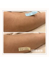 エアリアル 博多店/ヒザ下脱毛　before→after