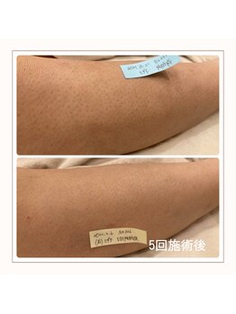 エアリアル 博多店/ヒザ下脱毛　before→after