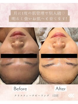 ルミエル 泉店(Lumiere)/ハーブピーリング