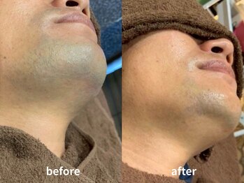 ラブ美長寿 沖縄本店(Lab)/【ビフォーアフター】ヒゲ脱毛