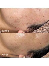 リラ(Lilas)/ニキビ/ホルモンバランス