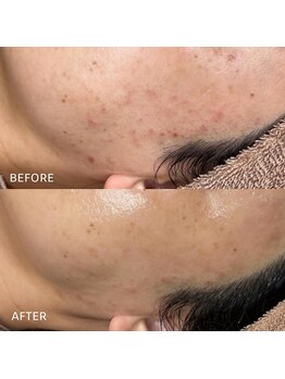 リラ(Lilas)/ニキビ/ホルモンバランス