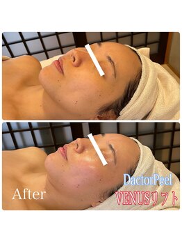 エクセレントビューティーサロン 艶(EN)/ダクトピール＆VENUSリフト