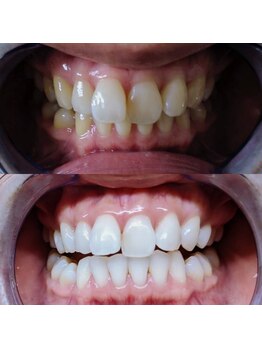 ライトケアサロン 表参道店(Light Care Salon)/ホワイトニング前後の色味