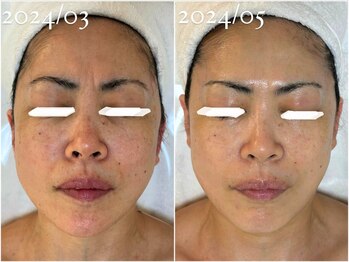 フォー(For...)/肌質改善・毛穴ケア◇ララピール