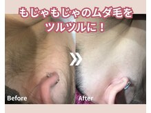 【ハイパワー脱毛】剛毛の方も大丈夫！つるつるキレイな肌に★