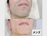 【メンズヒゲ脱毛・都度】3か所 9,900円