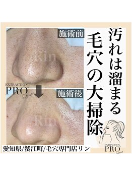 リン(Rin)/毛穴プロコース