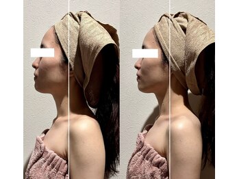 カルナ(CARNA)/小顔コルギ/リフトアップ効果大