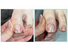 カラーホリック ネイルスパ(Colorholic Nailspa)/巻き爪補正