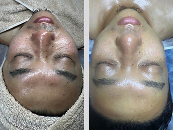 エムエー(MA)/肌育毛穴洗浄・髭脱毛