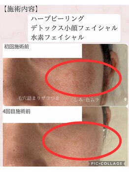 ネーム(Nemu)/ハーブピーリング+水素