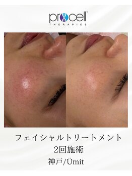 ユミト(Umit)/プロセルフェイシャル