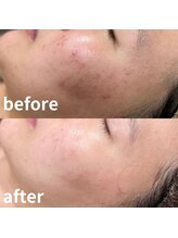 ドクターエイチ 麻布十番店(Doctor.H)/ハーブピーリングで根本ケア