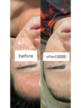 スパアルデバラン(spa.ALDEBARAN)/【ハーブピーリング(3回)】